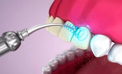 Принцип профессиональной чистки зубов