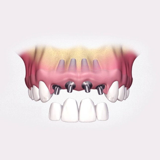 Импланты передних верхних зубов