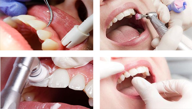 Этапы профессиональной чистки зубов