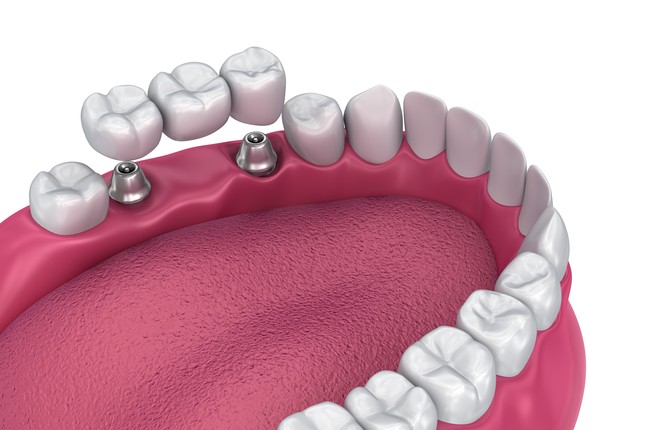 Один из принципов двухэтапной имплантации под ключ нижних жевательных зубов