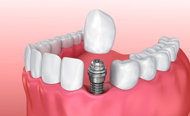 Одноэтапная имплантация под ключ переднего нижнего зуба