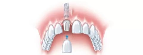 Принцип экспресс-имплантации переднего зуба