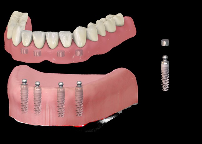 Принцип установки имплантов под протезы при полном отсутствии зубов