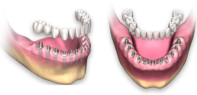 Установка 12 имплантов на нижнюю челюсть при полном отсутствии зубов