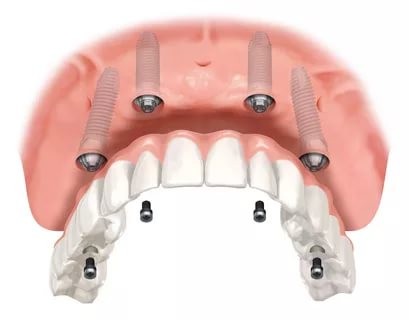 Установка имплантов all-on-4 при полном отсутствии зубов