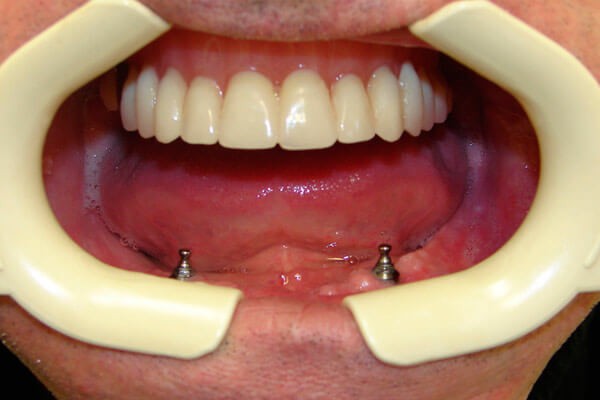 Вариант установки двух имплантов при полном отсутствии зубов