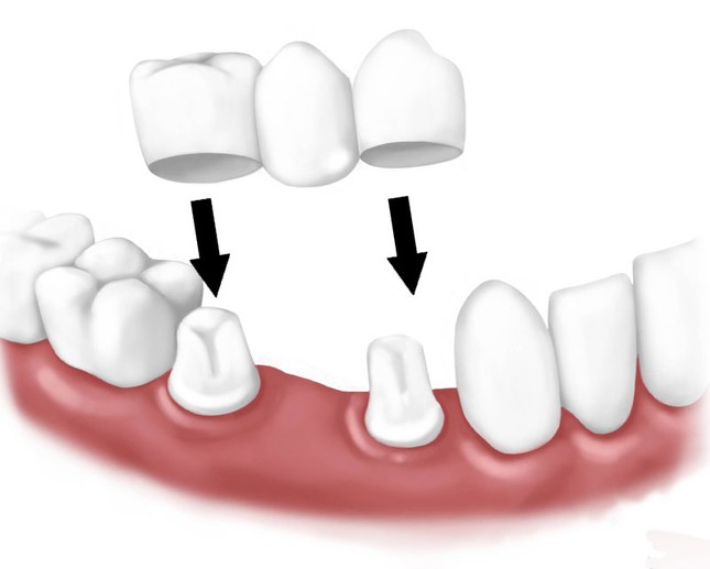 Имплантация нескольких зубов подряд (2,3 или 4 зуба) коронкой и имплантами