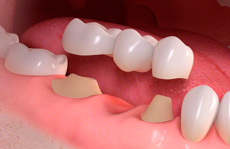 Металлокерамический мостовидный протез фото на зубах