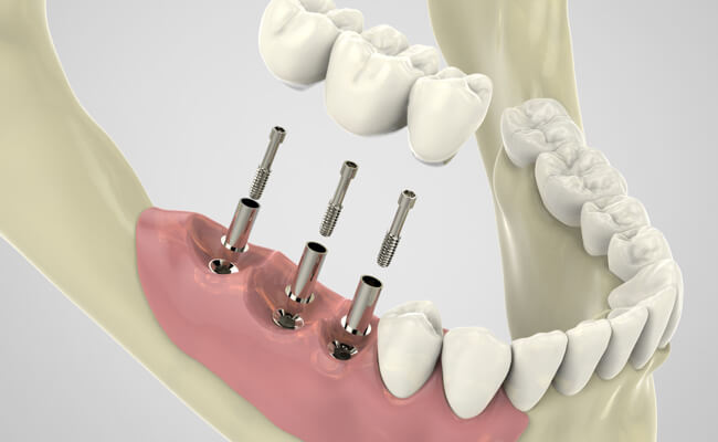 Протезирование зубов на имплантах: цена на протезирование на 4 имплантах на нижнюю челюсть в спб