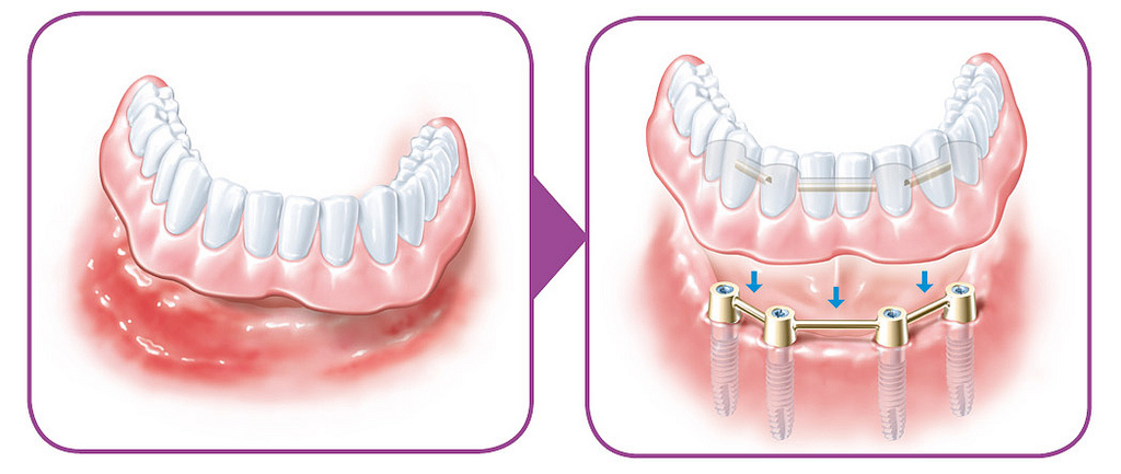 Принцип протезирования при полном отсутствии зубов