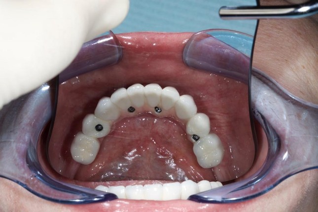 Коронки на молочные зубы