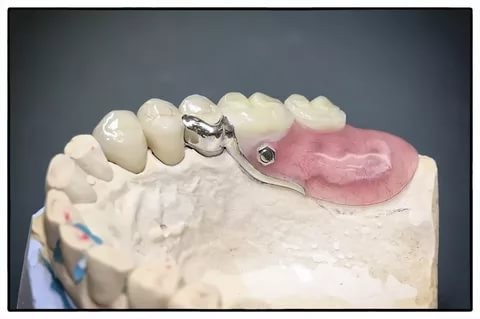 Протезирование одного зуба: особенности и способы
