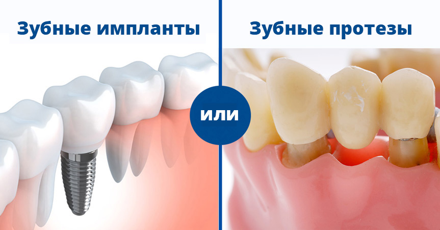 Одномоментная имплантация (сразу после удаления зуба)