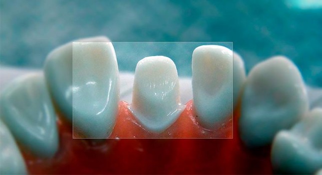 Общий вид зубов после препарирования