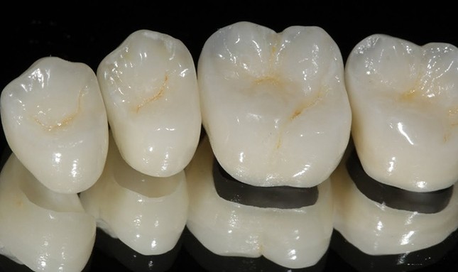Коронки из безметалловой керамики на передние зубы