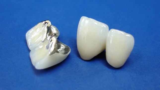 Металлокерамические коронки на передние зубы