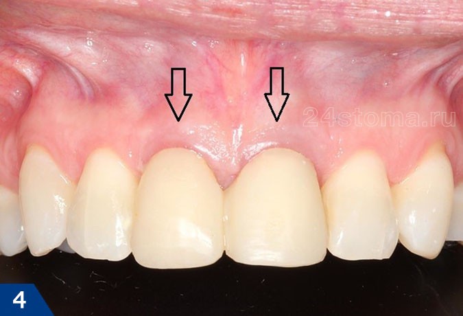 Установка временной коронки на зуб