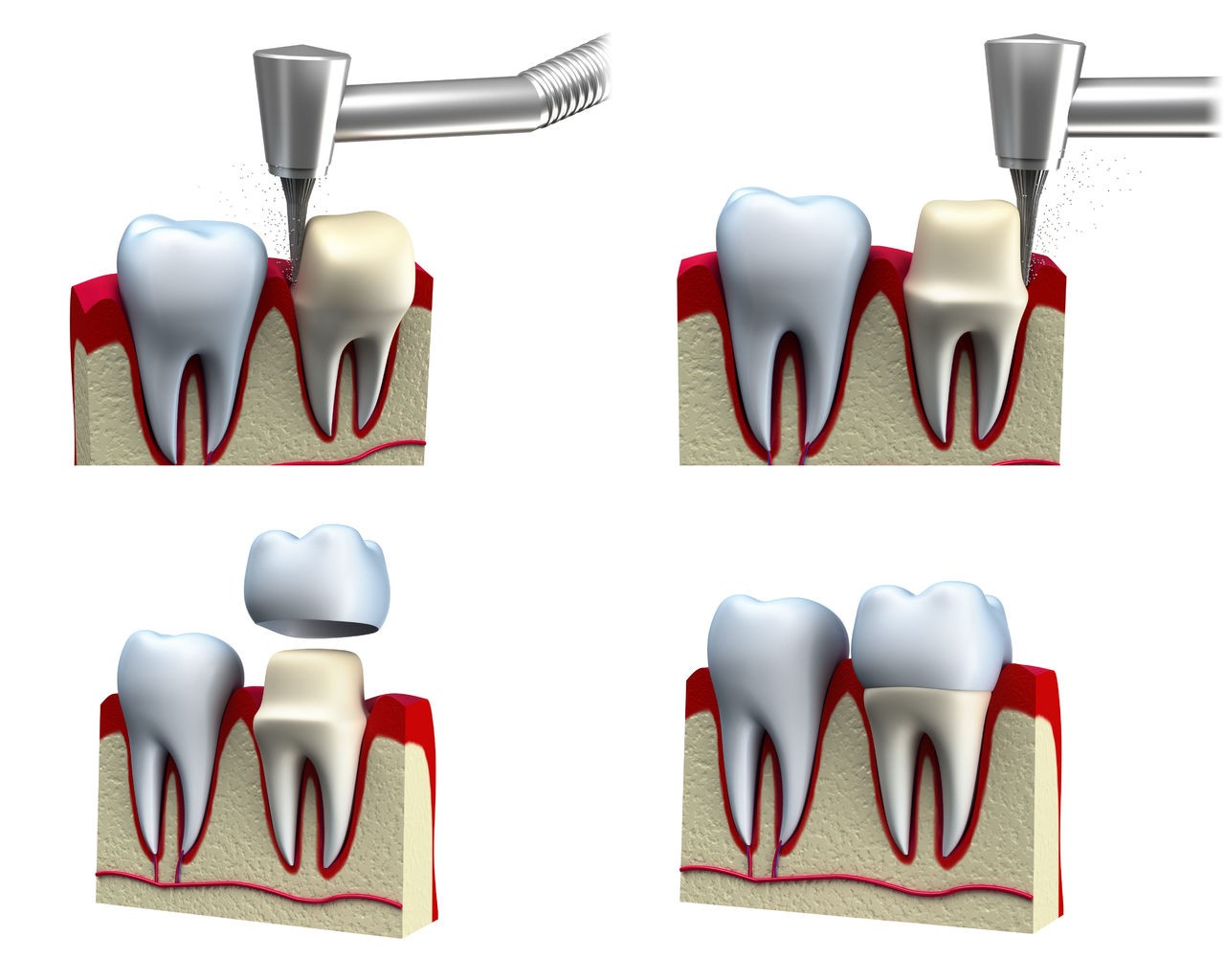 Принцип установки коронки на зуб