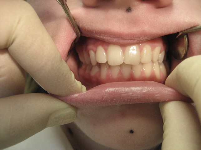 На этапе примерки зубного протеза