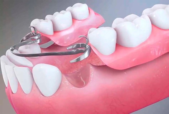 Установка частичного съемного зубного протеза