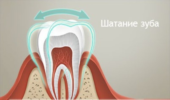 Лечение подвижности зубов