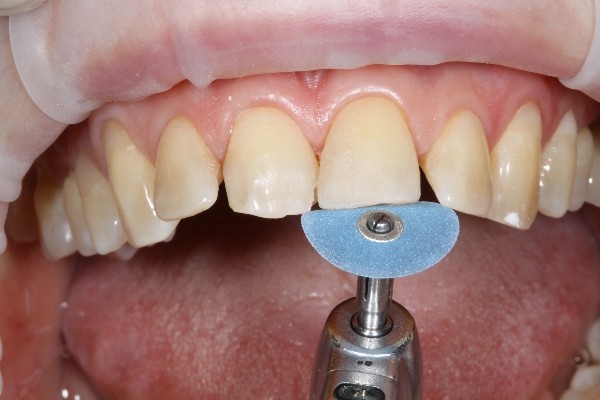 Как отбелить пломбу на переднем зубе?