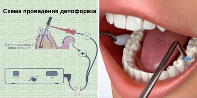 Депофорез кисты зуба