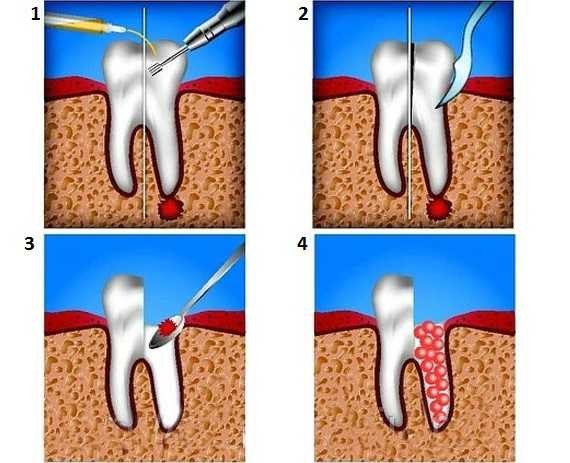 Способы лечения кисты зуба