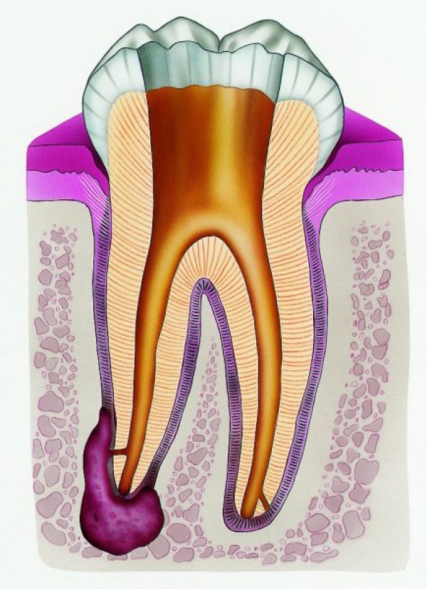 Почему гранулема зуба требует немедленного лечения