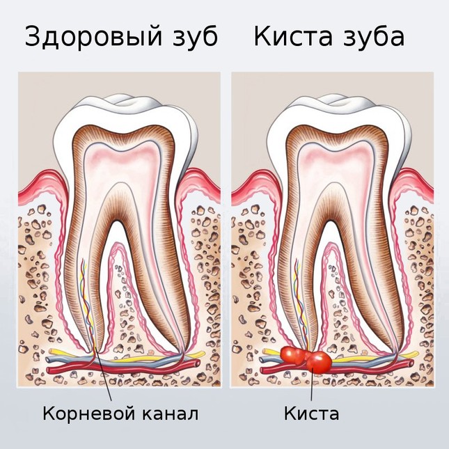 Киста зуба – лечение, симптомы