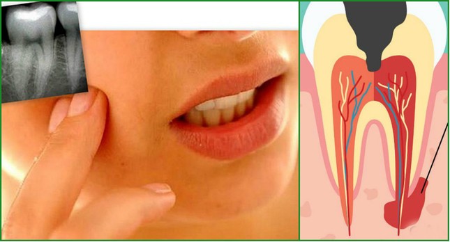 Киста зуба - лечится или нет, как можно вылечить и когда удалять зуб