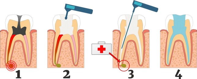 Терапевтическое лечение кисты зуба