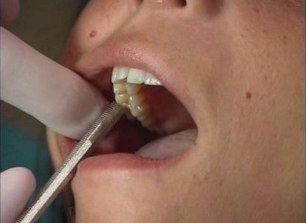 Перкуссия зубов