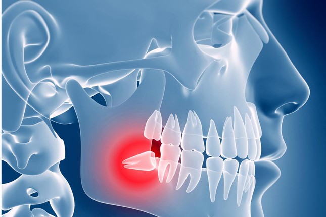 Что такое зубной флюс и как от него избавиться?