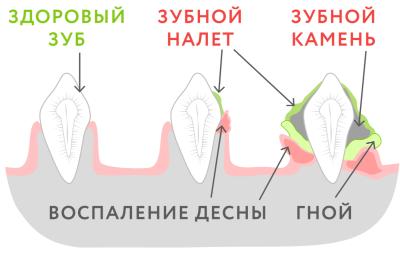 Необходимость ультразвуковой чистки зубов