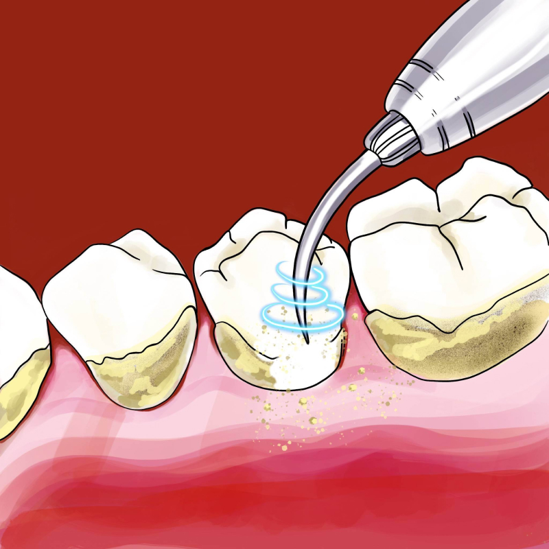 Суть ультразвуковой чистки зубов