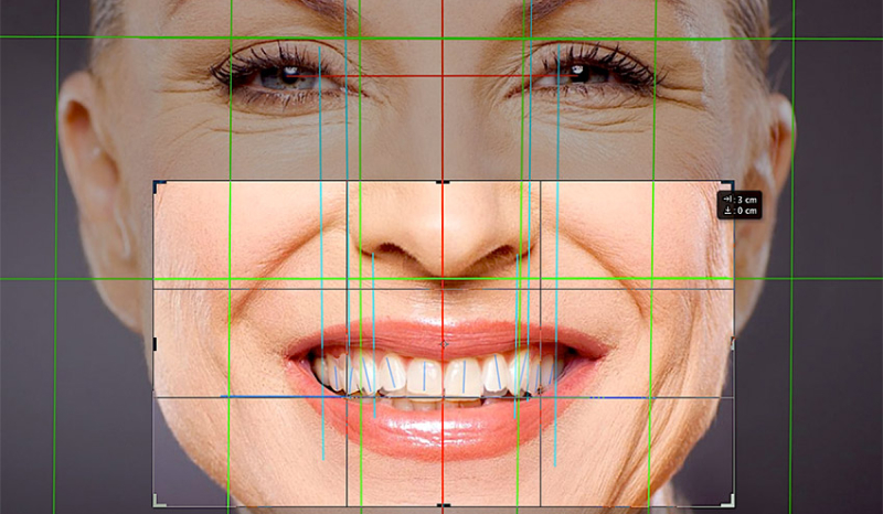 На этапе 3D-моделирования улыбки