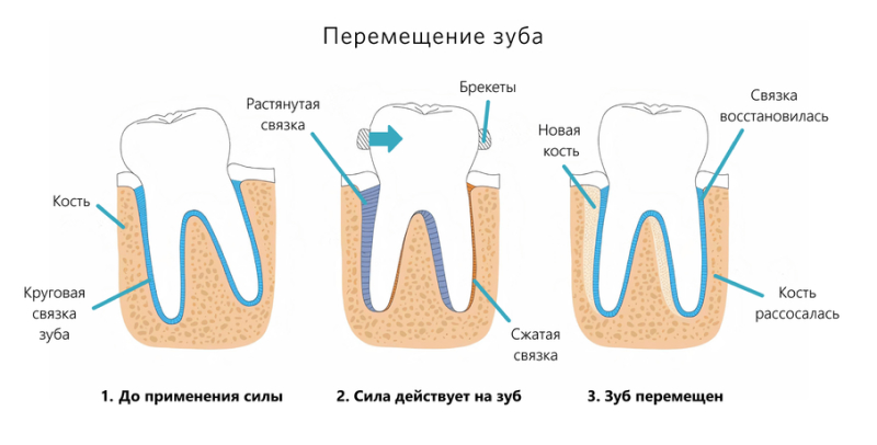 При коррекционном лечении зубы перемещаются благодаря силе ортодонтических устройств