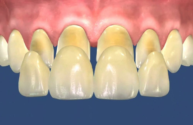 В процессе непрямой реставрации зубов