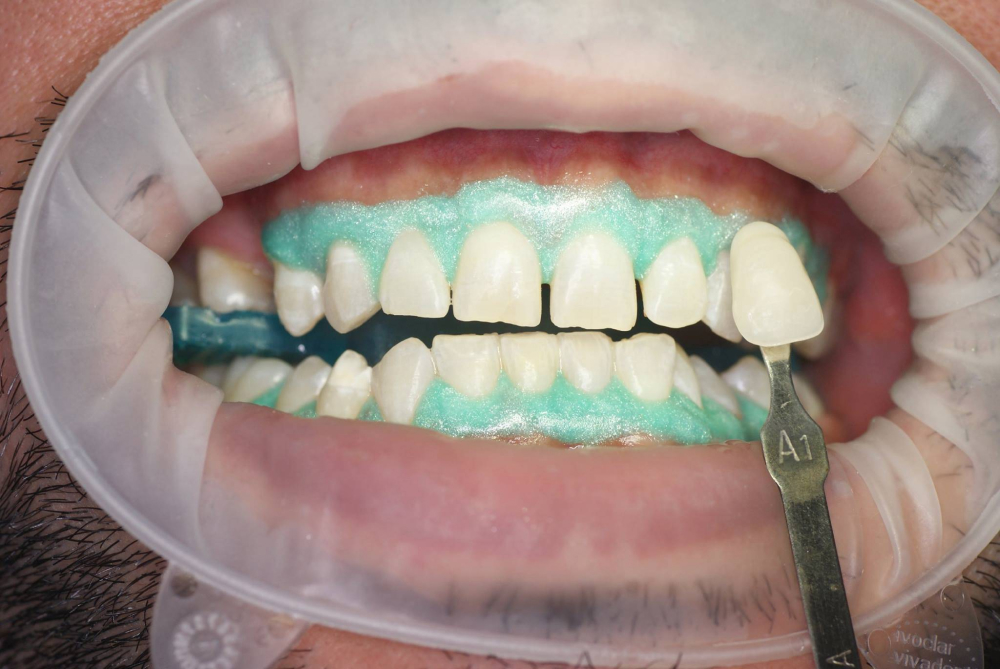 Защита тканей на этапе отбеливания зубов