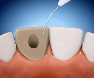 Принцип внутриканального отбеливания зубов