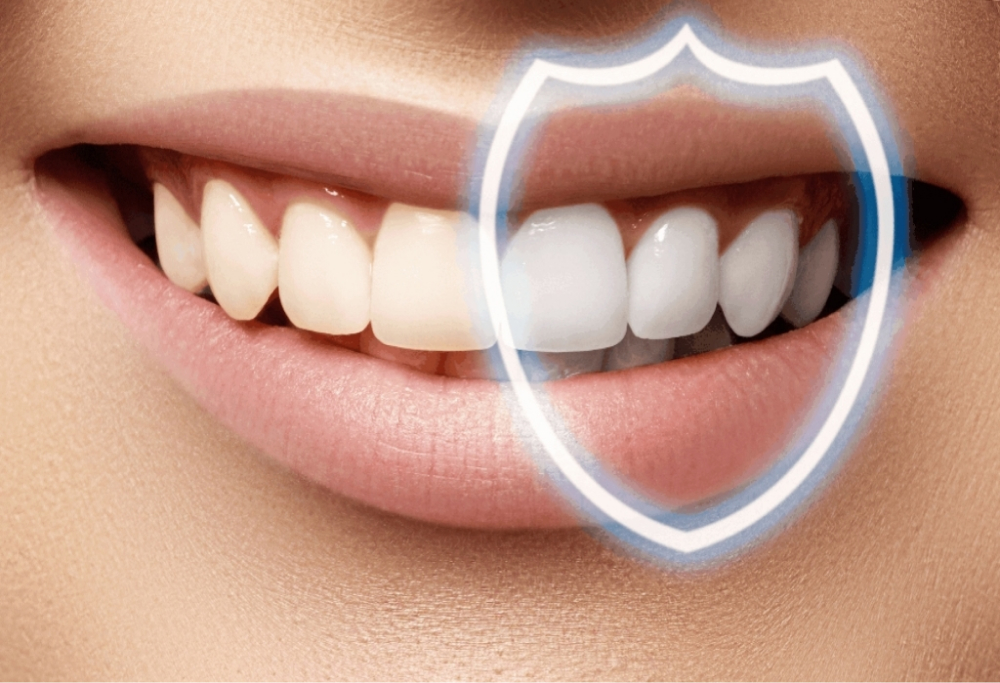 Эффект после покрытия зубов эмалью