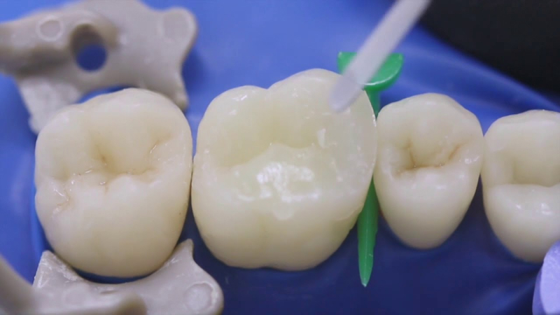 Реставрация светоотверждаемыми материалами - эффективный и безболезненный метод реставрации зубной единицы