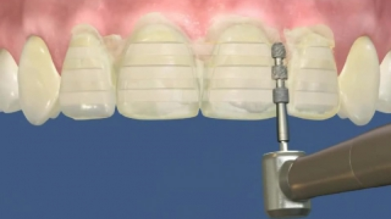 На этапе препарирования зубов перед установкой виниров E-max