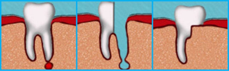 Удаление зуба семерки. Гемисекция и ампутация корня. Этапы гемисекции корня зуба.