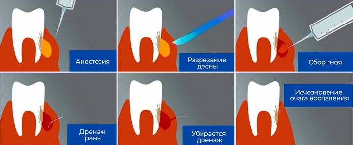Температура после лечения зуба. Серозный периостит челюсти. Периостит надкостницы зуба. Одонтогенный периостит.