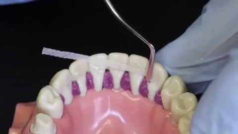 Процесс шинирования зубов