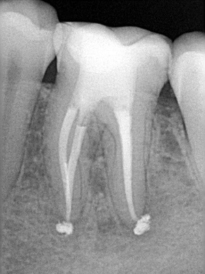 Гемисекция зубов