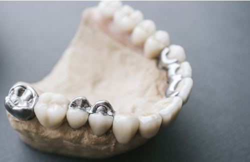 Драгоценные металлы в стоматологии
