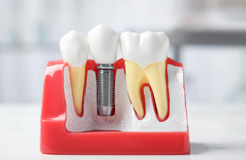 У пациентов с атрофией кости есть больше вариантов с новым зубным имплантатом